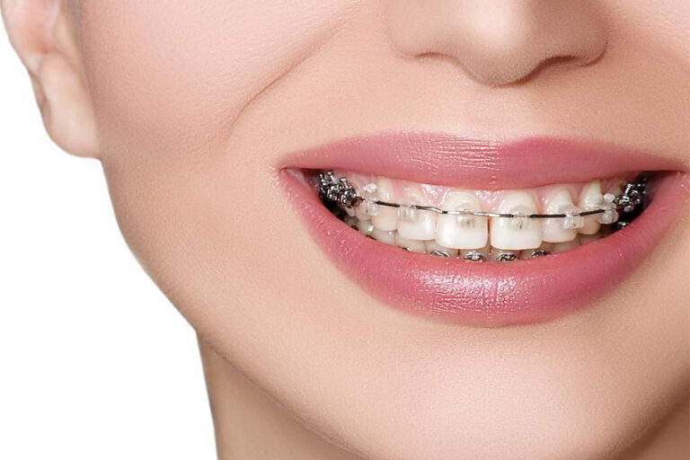 Top reasons why you should consider Invisalign