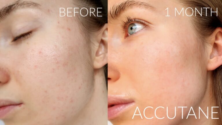 How does Accutane permanently cure acne?