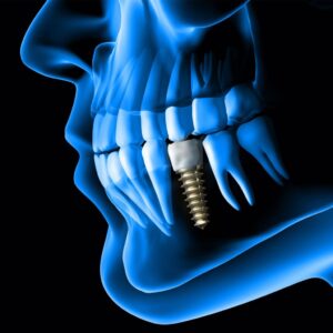 Affordable Dental Implants in Dubai