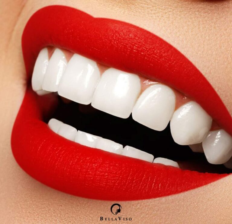 The Best Veneers in Dubai: Achieve Your Dream Smile with Expert Cosmetic Dentistry
