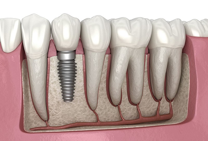 Dental Implants services