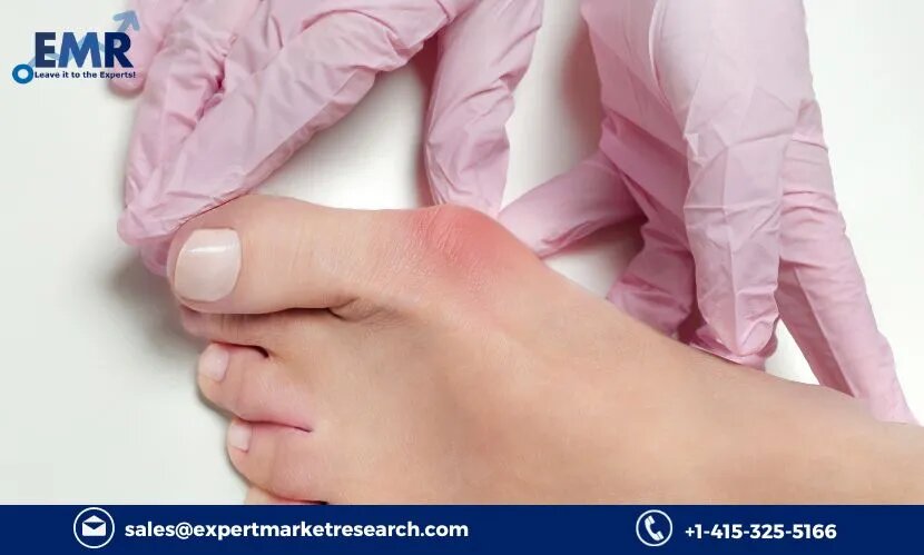 Hallux Valgus Treatment Market