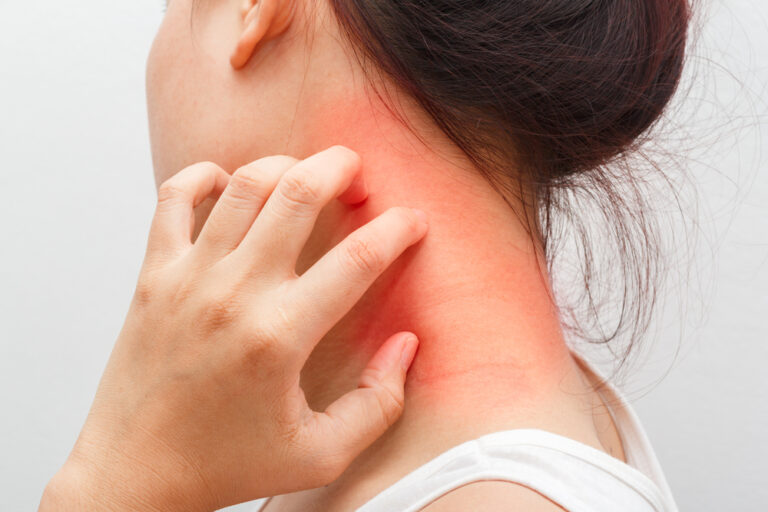 Atopic Dermatitis and Autoimmune Diseases: Exploring Overlapping Conditions