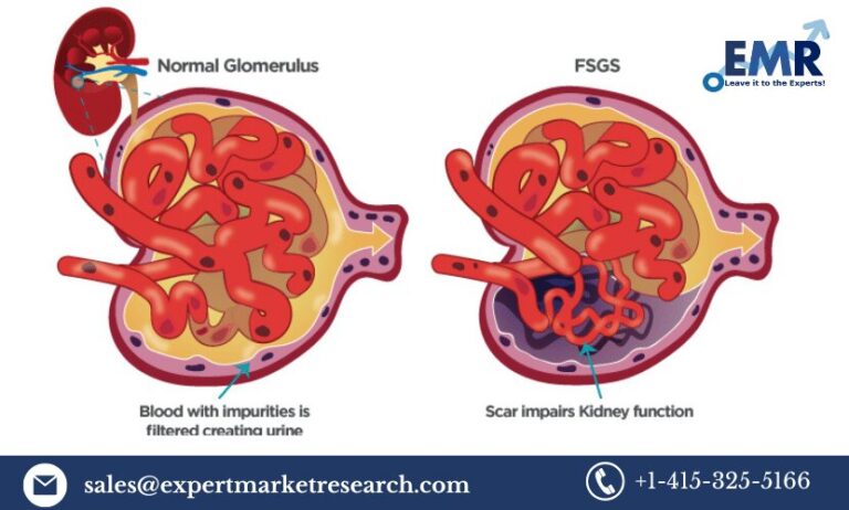 Focal Segmental Glomerulosclerosis (FSGS) Treatment Market Size, Price, Share, Trends, Growth, Report and Forecast 2023-2031