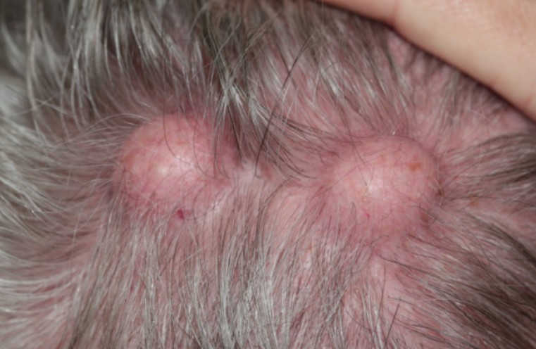 wrinkles treatment cypress ca